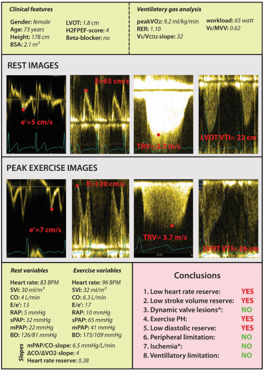 Proud on this new paper with superstars #BarryBorlaug @PieterMartensMD @FH_Verbrugge @HerbotsLieven and @PaulDendale 
pubmed.ncbi.nlm.nih.gov/34110608/
307 patients with unexplained dyspnea had combined #ExerciseEchocardiography and CPET