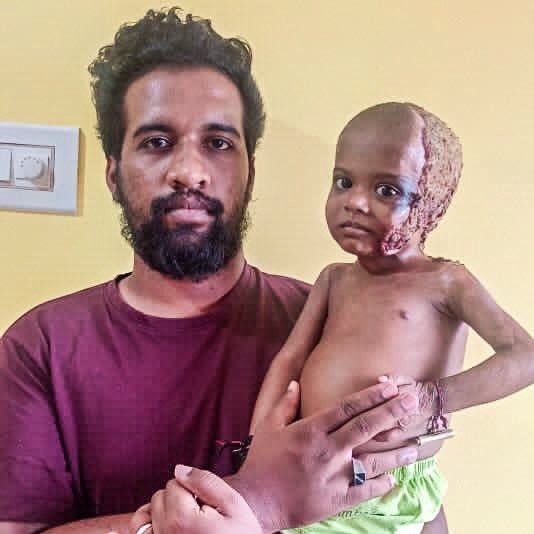 ketto's tweet image. “My daughter is suffering from severe burns. It pains me to see her in this state &amp;amp; I need your help to afford her treatment. Please help.”

To support: bit.ly/Save-Aafifa