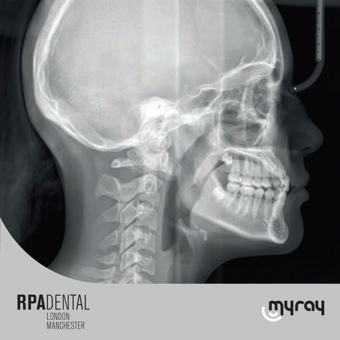 HyperionX9 pro 
Teleradiography 

Latero-Lateral: with bony structures and soft tissue profile, essential for
cephalometric studie.

  Antero-Posterior: to determine asymmetries and malocclusions for a
correct treatment.

  #dentistry