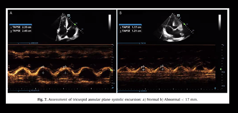 Demystifying Right Heart w/Ultrasound @MelissaMyersMD #rebellion21 #thepeoplesventricle
Make decisions early
PSLX - RV/aortic outflow/LA should be ~ same size
PSSX - D-sign
4CA - Great view of all chambers; McConnell sign
TAPSE~mortality
Acute = RV free wall <5mm in end diastole