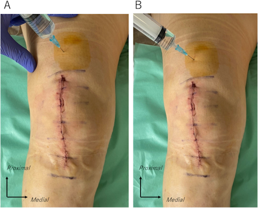 Percutaneous periarticular analgesic injection at one day after simultaneous bilateral total knee arthroplasty: an open-label randomized control trial josr-online.biomedcentral.com/articles/10.11…