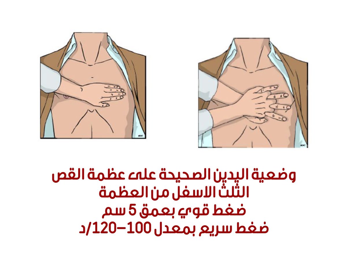 AlBugamiMM's tweet photo. الكثير شاهد اليوم سقوط الاعب اريكسون مغشيا عليه بعد توقف قلبه تماما!

اللاعب .. بعد مشيئة الله وفضله .. استعاد وعيه وعاد قلبه للنبض بسبب عملية الانعاش القلبي الرئوي الذي تم له

من المهم معرفة اساسيات الانعاش

فضلوها .. فقد تكون سبب في انقاذ شخص ما

تذكر - اطلب المساعدة اولا (997) https://t.co/GGNAZP7PS4