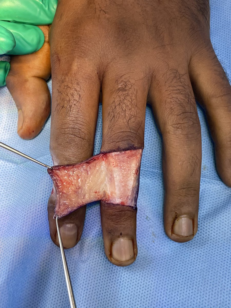 AlFaqeehF's tweet photo. - Incision and dissection carried out preserving the extensor paratenon.
- Donor site covered by a split-thickness skin graft from forearm.
- Flap will be divided after 3 weeks..
#plastic_surgery #Residency
#hand_surgery
#reconstructive_surgery https://t.co/8yqLGzy1aG