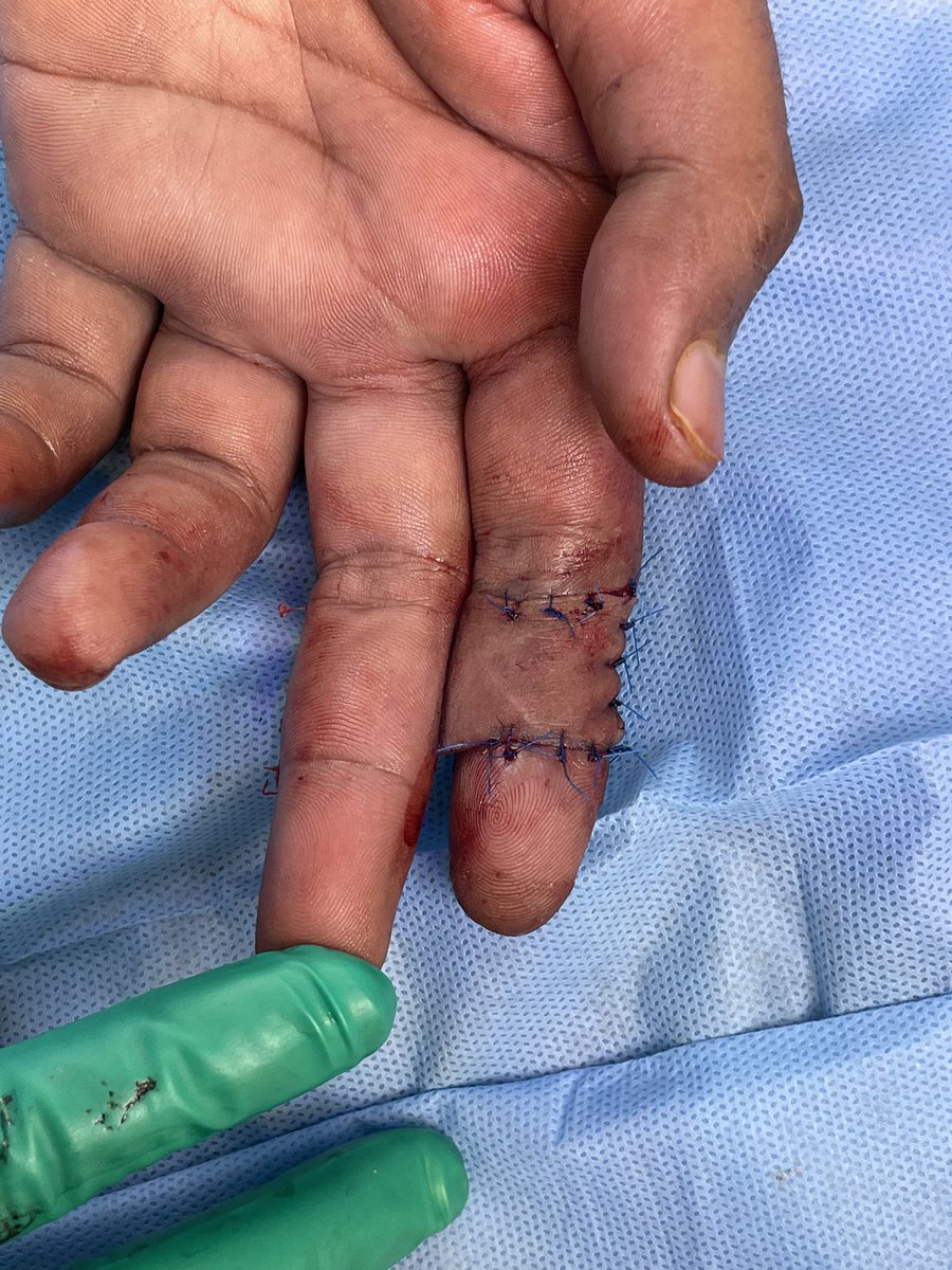 AlFaqeehF's tweet photo. - Incision and dissection carried out preserving the extensor paratenon.
- Donor site covered by a split-thickness skin graft from forearm.
- Flap will be divided after 3 weeks..
#plastic_surgery #Residency
#hand_surgery
#reconstructive_surgery https://t.co/8yqLGzy1aG