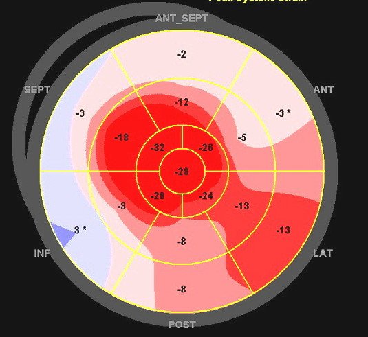 Jae K. Oh (@jaekoh2) on Twitter photo Doppler, Color M mode, and strain from a patient with HCM. A good example of short IVRT and "L" wave indicating increased filling pressure. E velocity flow propagation velocity does not work in a small LV as in HCM.@jamil_tajik <a href="/ASE360/">American Society of Echocardiography</a> <a href="/aae_echo/">AAE-Asian-Pacific Association of Echocardiography</a> <a href="/KyleWKlarich/">Kyle W. Klarich</a> <a href="/DavidWienerMD/">David H. Wiener, MD</a> Doppler, Color M mode, and strain from a patient with HCM. A good example of short IVRT and "L" wave indicating increased filling pressure. E velocity flow propagation velocity does not work in a small LV as in HCM.@jamil_tajik <a href="/ASE360/">American Society of Echocardiography</a> <a href="/aae_echo/">AAE-Asian-Pacific Association of Echocardiography</a> <a href="/KyleWKlarich/">Kyle W. Klarich</a> <a href="/DavidWienerMD/">David H. Wiener, MD</a>