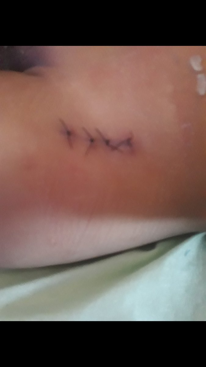 E infelizmente a pior fase de todas!
Cirurgia de urgência!
Aí eu pergunto <a href="/DamaresAlves/">Damares Alves</a> e <a href="/minsaude/">Ministério da Saúde 🩵</a> , é certo a <a href="/pmsjmoficial/">Prefeitura Municipal de São João de Meriti</a> não fornecer o leite dele, com a desculpa que estão providenciando a compra há 7 meses?
7 meses!