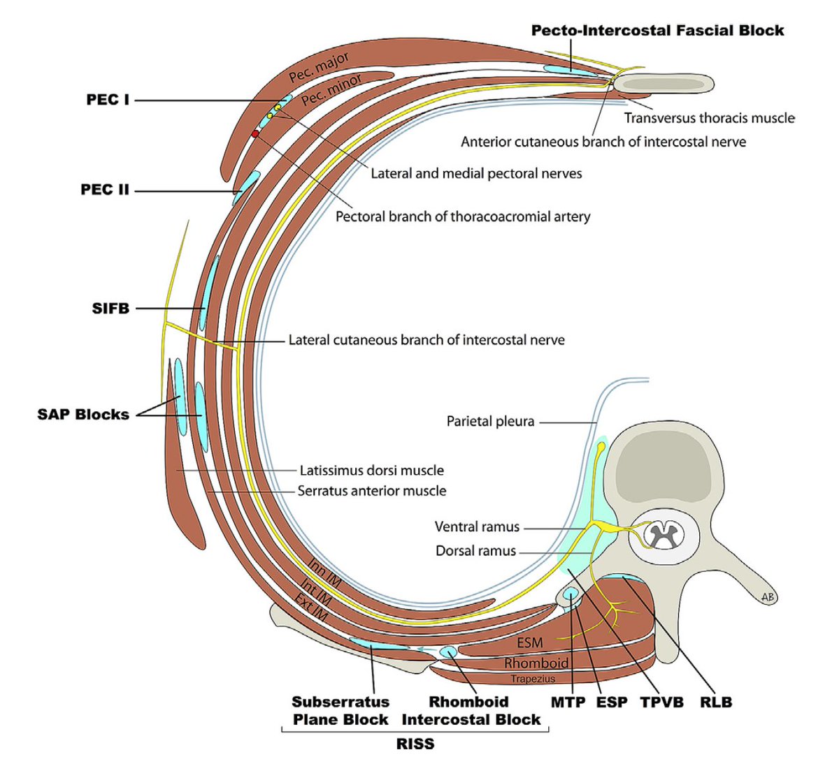 jon_bailey_anes's tweet photo. @KalagaraHari @Ropivacaine @ASRA_Society @dr_rajgupta @shaskinsMD @JarnaShahMD @BridgetPulos @SreeHPraveenKO1 @SretroPMD @galusweegie @DrJeniMD @HoltzMaggie @PeterRoseAnesth @PeterMerjavy @AkuaGyambibi @jaimin1287 @prerana10 @amit_pawa @EMARIANOMD @ChrisPrabhakar @NarouzeMD @KiJinnChin @kaohesham @JanBoublikMDPhD @Nadia_Hdz_MD @jattarab @KukrejaPromil @ajrmacfarlane @claralexlobo @mokaeleni @rljohnsonmd @jeffgadsden @DrTimJen @PatrickWongMD @MKwesiKwofie Yes, that illustration was from Mittnacht
https://t.co/g5JG8Xin7B
Here's another favorite from Fitzgerald. Doesn't show the distribution of PIFB, but gets to the heart of the nomenclature debacle. #sameplane https://t.co/Oos63Jtyj5 https://t.co/OUK2zCPy3E