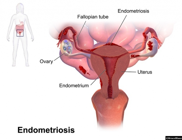 All_infertility's tweet photo. L’endométriose est ainsi responsable de douleurs pelviennes invalidantes et aussi, dans certains cas, d’infertilité. Ces symptômes ont un impact majeur sur la qualité de vie des personnes atteintes avec un retentissement important sur leur vie personnelle et conjugale mais https://t.co/8c75EA5sMS