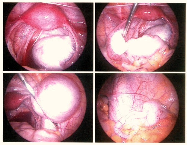 All_infertility's tweet photo. Les médecins se veulent rassurants : dans 1/3 des cas, l’endométriose ne se développe pas, stagne, voire régresse grâce au traitement (médical ou chirurgical) ou de façon spontanée, notamment pour les formes superficielles. Cependant, on sait aussi que certaines endométrioses .. https://t.co/mO6fAAOOvP