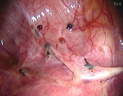 All_infertility's tweet photo. – l’endométriose superficielle (ou péritonéale) qui désigne la présence d’implants
d’endomètre ectopiques localisés à la surface du péritoine 
– l’endométriose ovarienne : l’endométriome ovarien est un kyste de l’ovaire caractérisé par son contenu liquidien couleur chocolat.. https://t.co/PgzOsHN5rj