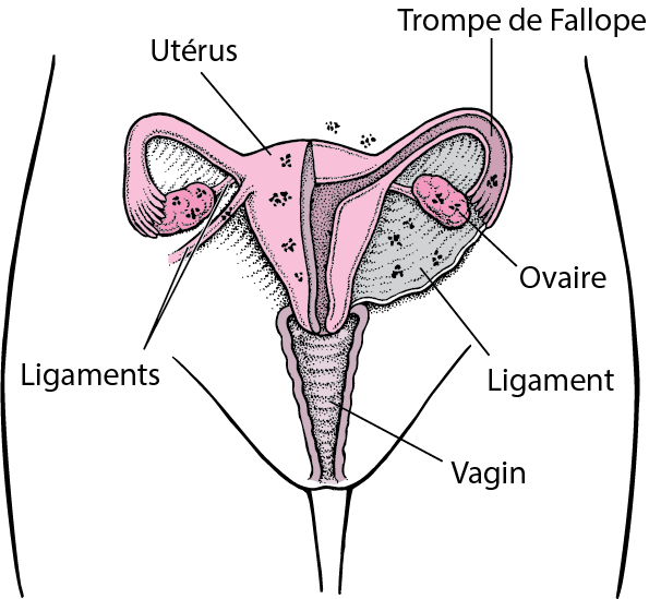 All_infertility's tweet photo. l’endométriose pelvienne profonde (ou sous-péritonéale) correspond aux lésions qui s’infiltrent en profondeur à plus de 5 mm sous la surface du péritoine. L’endométriose profonde peut toucher typiquement les ligaments utérosacrés (50 % des cas), le
cul-de-sac vaginal postérieur.. https://t.co/ayCLnIelxu