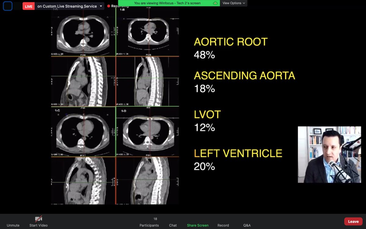 WINFOCUS WORLD (@winfocus) on Twitter photo Theory behind #chest compressions - #CPR.
Is hand position taught today optimal? Pressing on nipple-line only targets LV in 20%!!!!! WHAT ARE WE REALLY PUSHING ON?!?
<a href="/FTeranMD/">Felipe Teran, MD MSCE</a> #TEE
#WINFOCUS21 Theory behind #chest compressions - #CPR.
Is hand position taught today optimal? Pressing on nipple-line only targets LV in 20%!!!!! WHAT ARE WE REALLY PUSHING ON?!?
<a href="/FTeranMD/">Felipe Teran, MD MSCE</a> #TEE
#WINFOCUS21