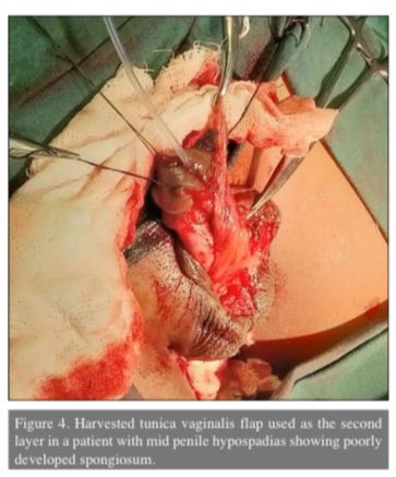 🆕 Choosing an ideal second layer cover in #snodgrass repair for various types of hypospadias

#hypospadias #fistula #UroSoMe #complications #urethra #peduro
#SoMe4PedSurg 

<a href="/dr_sankapal/">Dr Prakash Sankapal</a> <a href="/Dr_MayankAg/">Mayank Agrawal 🇮🇳</a> <a href="/Uroweb/">European Association of Urology (EAU)</a> <a href="/AmerUrological/">Amer. Urol. Assn.</a> <a href="/ESPUorg/">ESPU</a> 

Article Link : 

turkishjournalofurology.com/en/choosing-an…
1/2