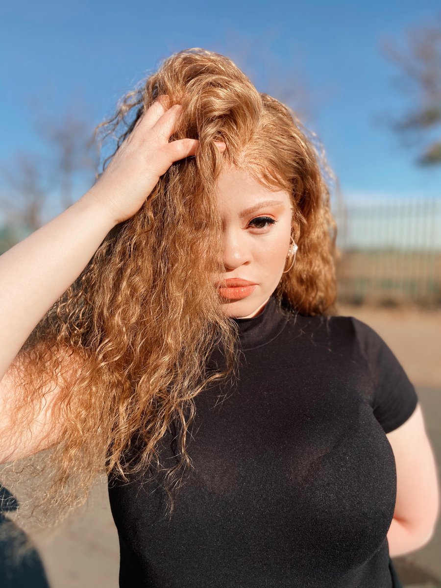 Snow_Thee's tweet image. #AlbinismAwarenessDay