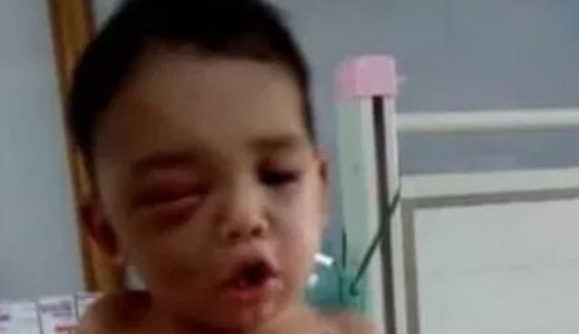la_patilla's tweet photo. Conmoción en Lara: Bebé de un año fue mordido en la cara por una mapanare (FOTO) https://t.co/08pzWmcBAQ https://t.co/xhajKdZUpH