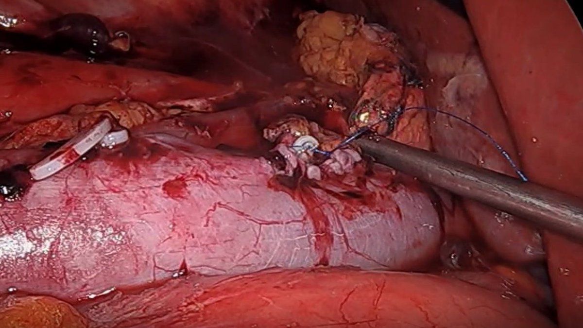 Laparoscopic Radical Nephrectomy with inferior vena cava (IVC) Thrombectomy 

To watch the full video: youtu.be/A53LtmJy6Hk

#nephrectomy #urology #laparoscopy

<a href="/KartalUroloji/">KARTAL ÜROLOJİ</a> <a href="/akcaoktay_/">Oktay</a> <a href="/Orkunt8/">Orkunt özkaptan</a>