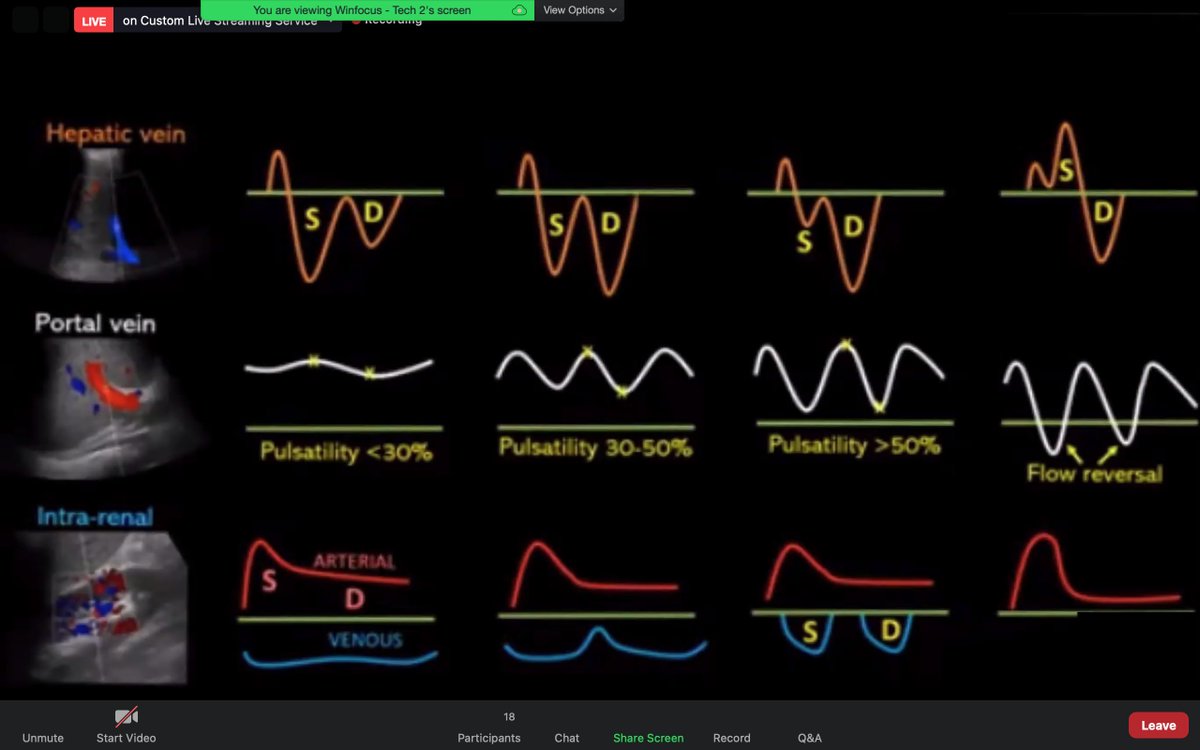 WINFOCUS's tweet photo. #VEXUS protocol; "main idea in a nutshell; as RA pressure increases, organ congestion increases. This leads to lesser organ perfusion"
@cianmcdermott #PoCUS #FoCUS #WINFOCUS21 https://t.co/Qaqj01n5hm