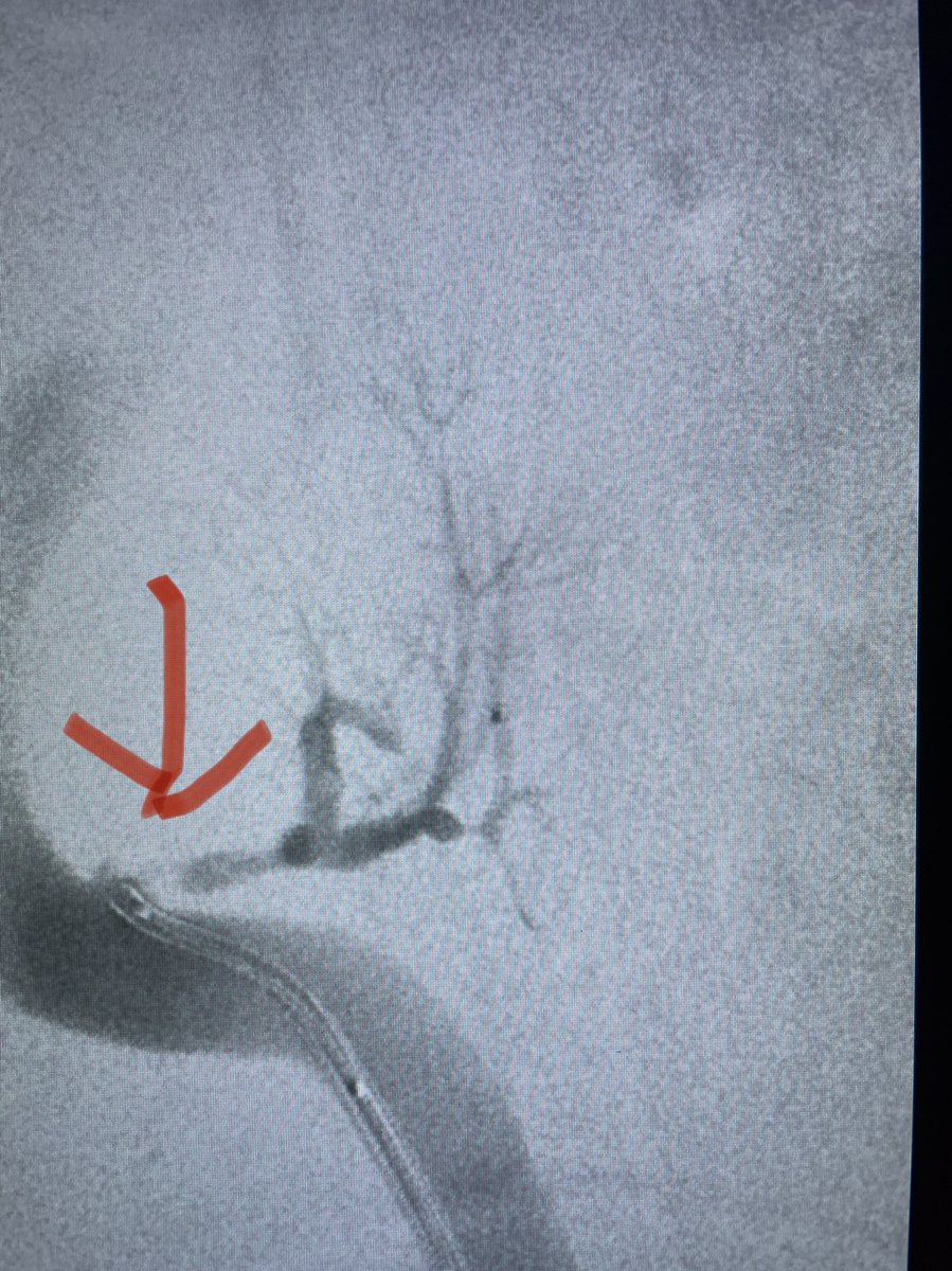irdocnigeria's tweet photo. Sunday morning renal transplant artery stenosis/near occlusion. Hard work to stent and salvage by #irad in #nigeria https://t.co/JsbIcRFfwg
