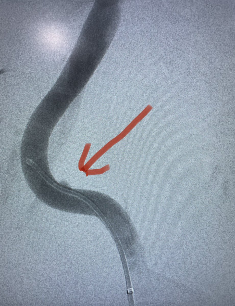irdocnigeria's tweet photo. Sunday morning renal transplant artery stenosis/near occlusion. Hard work to stent and salvage by #irad in #nigeria https://t.co/JsbIcRFfwg