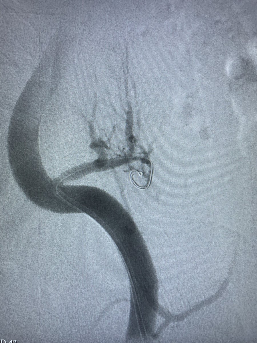 irdocnigeria's tweet photo. Sunday morning renal transplant artery stenosis/near occlusion. Hard work to stent and salvage by #irad in #nigeria https://t.co/JsbIcRFfwg