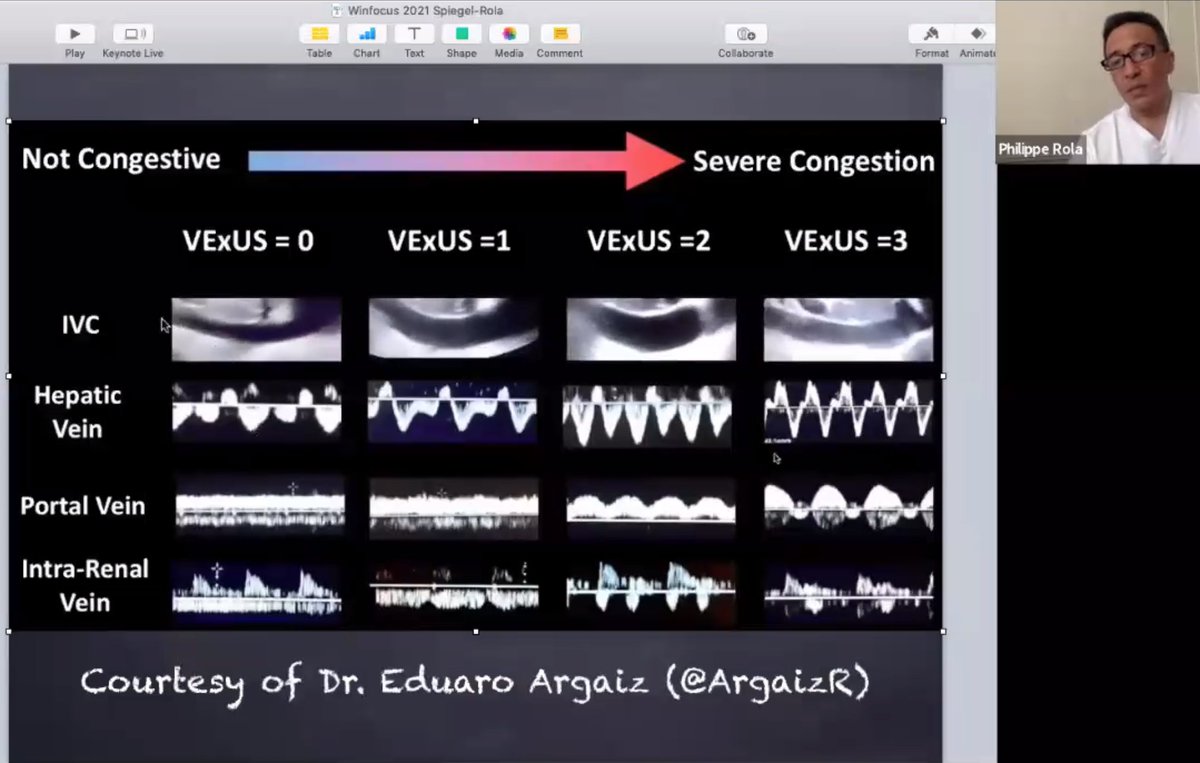 WINFOCUS WORLD (@winfocus) on Twitter photo "With #VEXUS:0, you dont have to look at rest. With #VEXUS:1 you have to check other elements as well"
"Looking at hepatic vein; the more flow ABOVE the baseline - more congestion"
<a href="/ThinkingCC/">Philippe Rola</a> #WINFOCUS21 "With #VEXUS:0, you dont have to look at rest. With #VEXUS:1 you have to check other elements as well"
"Looking at hepatic vein; the more flow ABOVE the baseline - more congestion"
<a href="/ThinkingCC/">Philippe Rola</a> #WINFOCUS21
