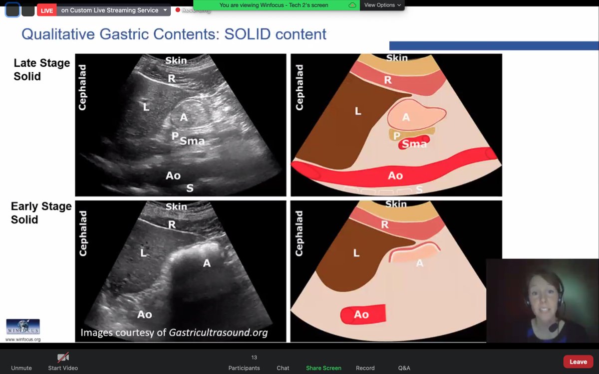 WINFOCUS WORLD (@winfocus) on Twitter photo Assessing prandial status; #POCUS #WINFOCUS21
EXCELLENT and INFORMATIVE review by <a href="/richellekruiss/">RichelleKruisselbrink</a> Assessing prandial status; #POCUS #WINFOCUS21
EXCELLENT and INFORMATIVE review by <a href="/richellekruiss/">RichelleKruisselbrink</a>