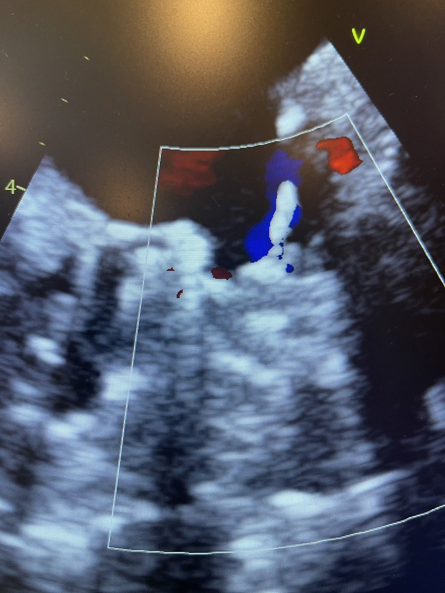 Second device placed acutely with good seal of both lobes and good stability