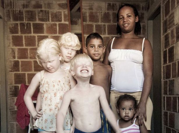 Sub-Saharan Africa is the region with the highest prevalence of albinism in the world, a territory in which people with this genetic disorder are "condemned to extreme poverty" and live with only one dermatologist for every 3.5 million inhabitants. NGO 'Beyond Suncare'.