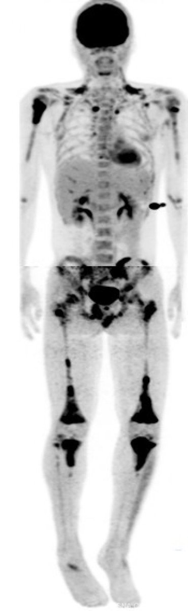 RSNACaseCollection_Editor (@rcc_editor) on Twitter photo Our jokes may be corn “knee” but its’ time for the #RSNACC Case of the week! What’s the diagnosis in this 14 yo male with atraumatic knee pain? bit.ly/3xbVm64
<a href="/RSNA/">RSNA</a> #NucMed <a href="/SNM_MI/">SNMMI</a> @officialEANM <a href="/nmroacnm/">NMRO ACNM</a> <a href="/SocPedRad/">The Society for Pediatric Radiology</a> <a href="/SSRbone/">Society of Skeletal Radiology</a>
#RadEd #PedsRad Our jokes may be corn “knee” but its’ time for the #RSNACC Case of the week! What’s the diagnosis in this 14 yo male with atraumatic knee pain? bit.ly/3xbVm64
<a href="/RSNA/">RSNA</a> #NucMed <a href="/SNM_MI/">SNMMI</a> @officialEANM <a href="/nmroacnm/">NMRO ACNM</a> <a href="/SocPedRad/">The Society for Pediatric Radiology</a> <a href="/SSRbone/">Society of Skeletal Radiology</a>
#RadEd #PedsRad