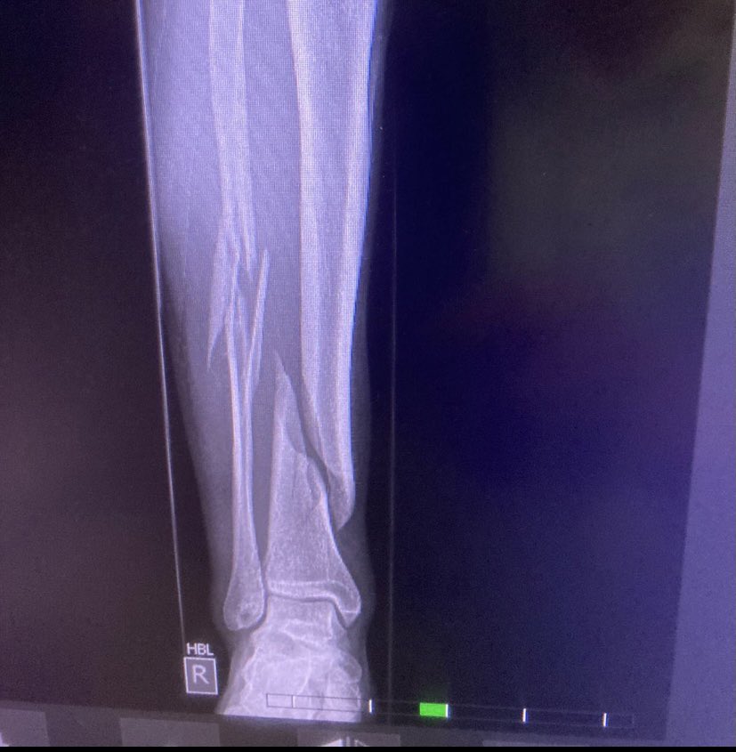 Not the result we were hoping for as the game progressed against <a href="/WhitefieldCC/">Whitefield CC</a> yesterday. A terrible injury on what seemed to be a run-fest of a game, but players health is more important than any sporting result! Wishing you a speedy recovery Mike 💚