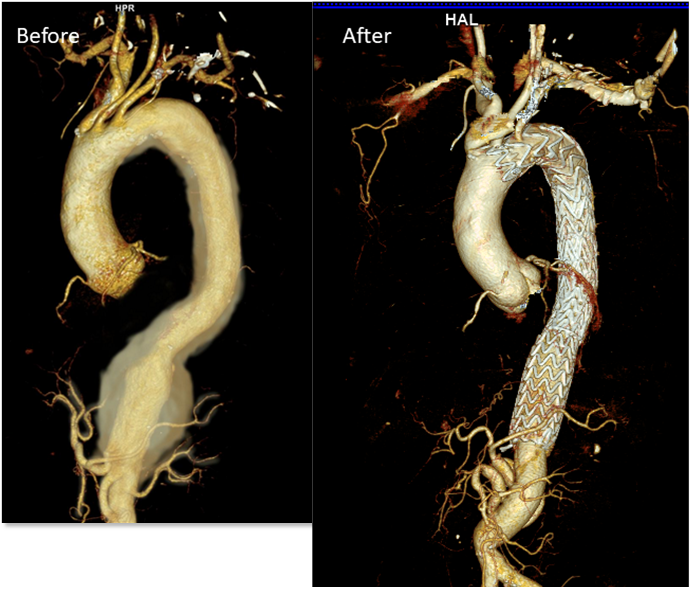 Extant II TAAA treated with hybrid repair and debranched first technique (ref doi.org/10.1016/j.xjtc….) which allows for significantly decreased blood loss and ischemia time to viscera #vascsurg #medtwitter #aorticsurgery