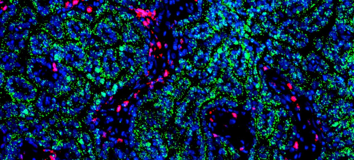 a tumour under the microscope