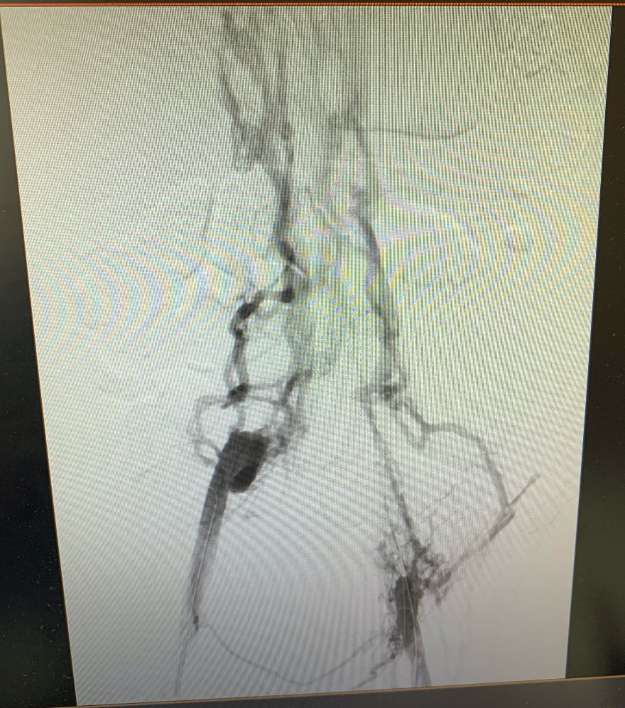 American Venous Forum | AVF tweet media