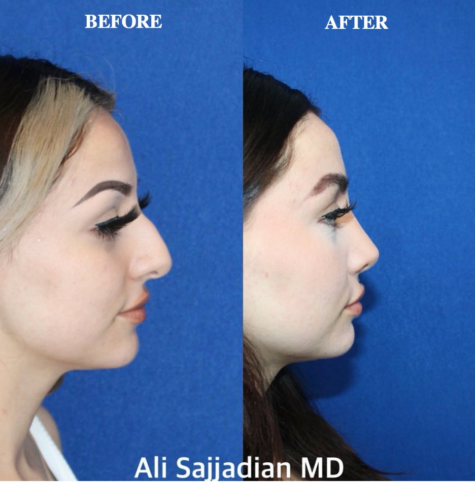Are you self-conscious about your nose and considering a Rhinoplasty? Its design is to give you the self-confidence to be everything you can be in your personal, and professional life. 

Schedule your COMPLIMENTARY consultation at (949)-515-0550
drsajjadian.com