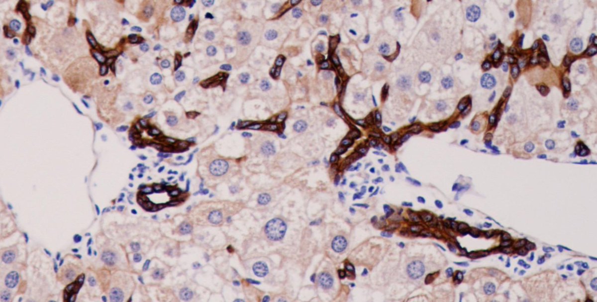 scisignal's tweet photo. Therapies that support the proliferation of liver progenitor cells may not be sufficient to stimulate tissue repair in patients with liver disease, suggests a new study from @crm_edinburgh. @boulter_lab @smlyons1 #LiverBiology #MechanismMatters https://t.co/LdLb9twXN4 https://t.co/2I4O56Q8RG