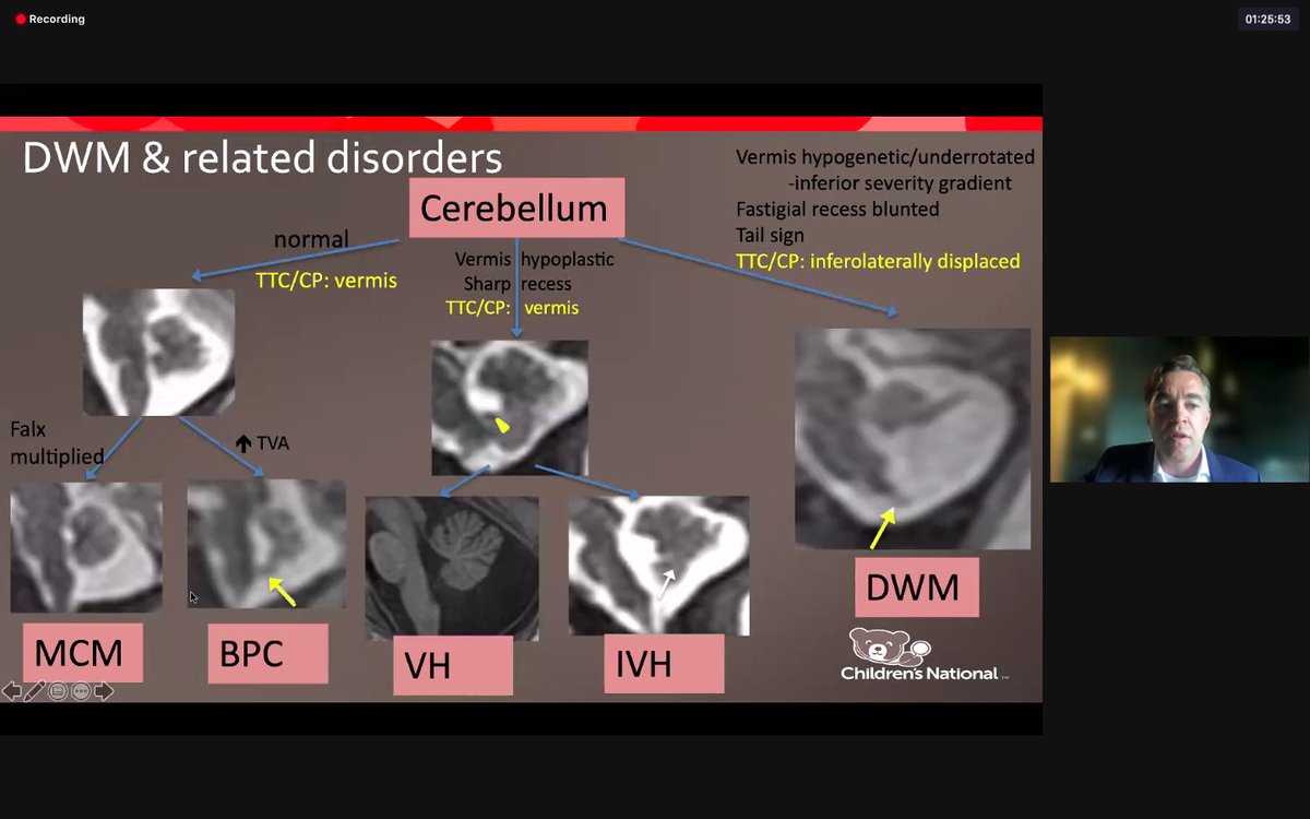 SusanPalasis's tweet photo. Exciting fetal neuro research being done at @ChildrensNatl! Amazing talks by #Limperopoulos and @MTWhiteheadMD 

#PediNeurorad #IPTN @The_ASPNR @drmankad @MirskyDavid https://t.co/Y0756OTRrU