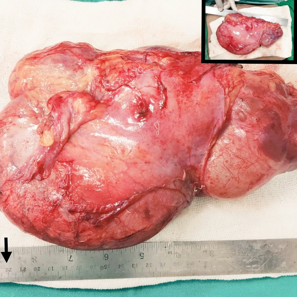 22year old female- Right PUJ Obstruction causing GIANT Hydronephrosis with Non functional  kidney.
Open Nephrectomy was performed.  
#urology
#nephrectomy
#PUJO
#Mumbai

<a href="/Uro_SoMe/">UroSoMe</a> <a href="/so_uro/">UroSoMe</a> <a href="/TurkJUrol/">Urology Research and Practice</a> <a href="/uroweb/">European Association of Urology (EAU)</a> <a href="/YouthUSI/">YOUsi</a> <a href="/jj_urology/">JJ School of Reconstructive Urology</a>