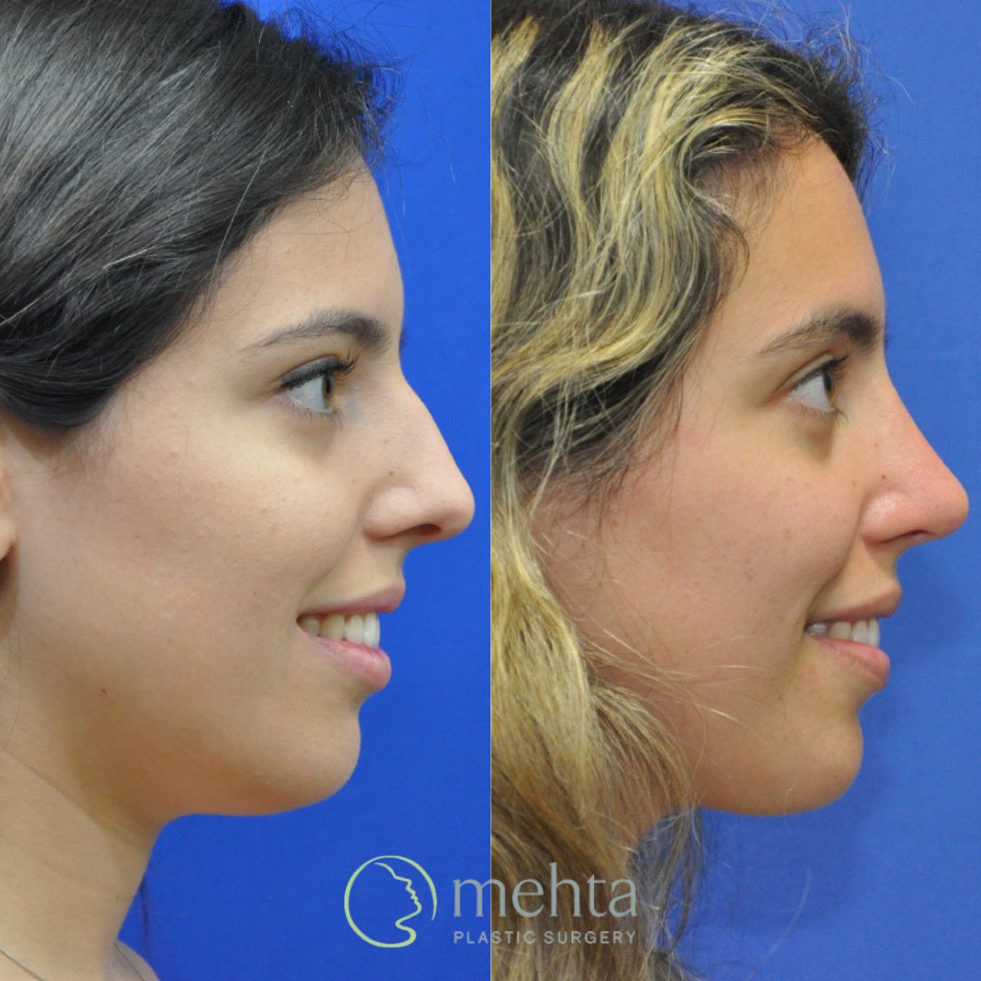 umangmehtamd's tweet photo. Check out our latest rhinoplasty before/after! This young woman was seeking a more refined and feminine appearance while also improving her breathing. She’s two years out from open rhinoplasty and septoplasty and couldn’t be happier! https://t.co/w0j6cAlVMK