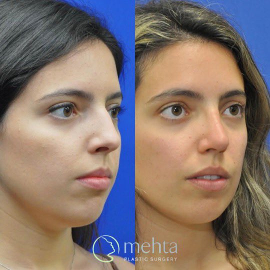 umangmehtamd's tweet photo. Check out our latest rhinoplasty before/after! This young woman was seeking a more refined and feminine appearance while also improving her breathing. She’s two years out from open rhinoplasty and septoplasty and couldn’t be happier! https://t.co/w0j6cAlVMK