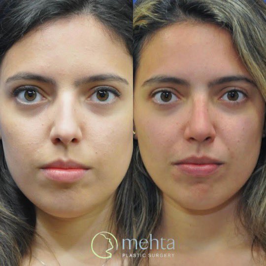 umangmehtamd's tweet photo. Check out our latest rhinoplasty before/after! This young woman was seeking a more refined and feminine appearance while also improving her breathing. She’s two years out from open rhinoplasty and septoplasty and couldn’t be happier! https://t.co/w0j6cAlVMK