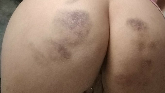How Lulu's bottom has become this colour?  You can see there:  https://t.co/C5rDVrzy7Y  #spanking #submissive<a href="/tag/spanking"class="tags"><span>#spanking</span></a><a href="/tag/submissive"class="tags"><span>#submissive</span></a><a href="/tag/bdsmvideos"class="tags"><span>#bdsmvideos</span></a>