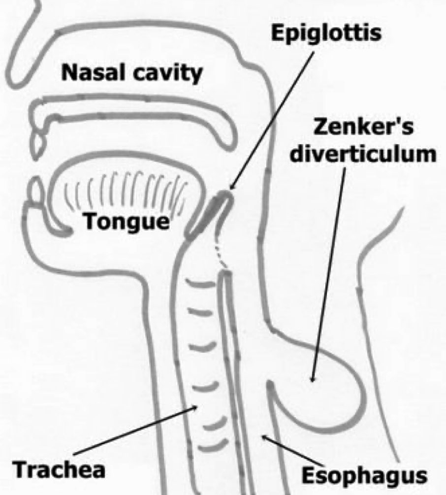 PDF] Upper esophageal ring due to gastric heterotopia | Semantic Scholar