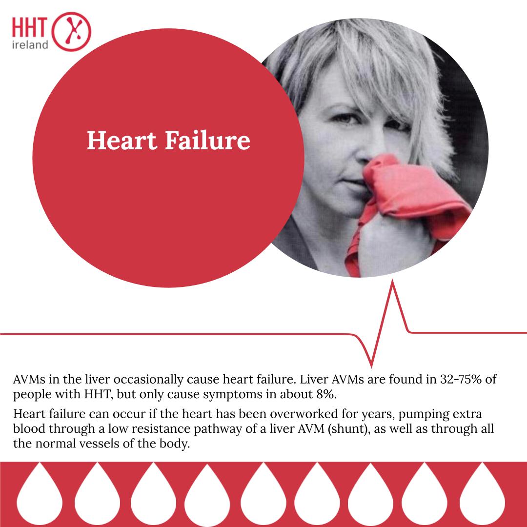 HHTireland's tweet photo. In recognition of World HHT Day on June 23rd, today’s nougat of information is about Heart Failure. #HHT #WorldHHTDay #HHTEurope #GetInformed #NougatsOfInformation https://t.co/g0Uk8kALYr
