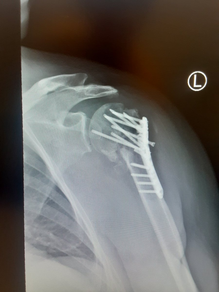 brianmcfa's tweet photo. This thing is starting to hurt more and more. I want to go back to work  but my injuries aren't cooperating. It's been almost eight months now and no real end in sight. https://t.co/yU6QTYudIx