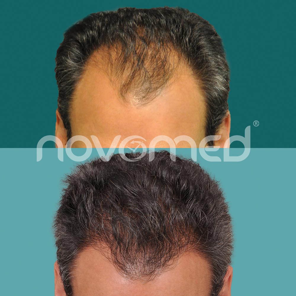 Novomed on Twitter "💁🏻‍♂️💁🏻‍♀️FUE (Follicular Unit Excision) hair