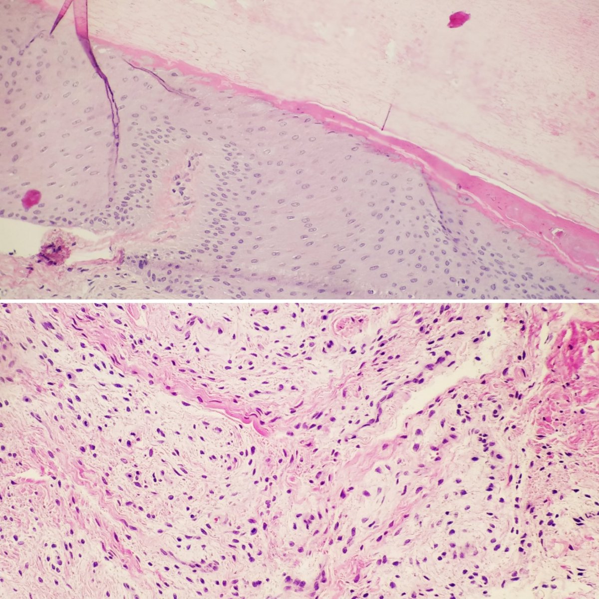 #pathspotter #pathresidents Site? Diagnosis? @Patholwalker @anjuthevirgo @archibhat3 @AnupamaArya12 @Kenny92954457 @joaquinnieves55 @RizviUroos @pembeoltulu @DrGeeONE @drsys02 @nusrat_xahra @Jazzopath1 @padmapathology1 @devyanidips @prashantmshetti @DrVasudevPrabhu @Meghna0630