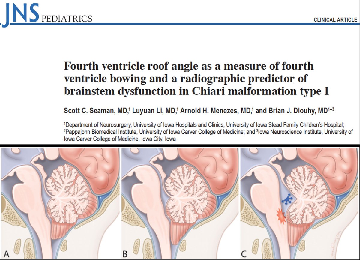 Brian Dlouhy MD (@thebraindocmd) on Twitter photo Great study <a href="/TheJNS/">Journal of Neurosurgery</a> by neurosurgery resident Scott Seaman <a href="/uiowa/">University of Iowa</a> <a href="/uihealthcare/">University of Iowa Health Care</a> <a href="/UIchildrens/">UI Health Care Stead Family Children's Hospital</a> <a href="/UIowaNeuro/">Iowa Neuroscience Institute</a> who identified a new radiographic marker for Chiari 1 malformation: if 4th ventricle bowed/enlarged, patient more likely to be symptomatic <a href="/PedsSection/">AANS/CNS Peds Section</a> bit.ly/3vY2HoU Great study <a href="/TheJNS/">Journal of Neurosurgery</a> by neurosurgery resident Scott Seaman <a href="/uiowa/">University of Iowa</a> <a href="/uihealthcare/">University of Iowa Health Care</a> <a href="/UIchildrens/">UI Health Care Stead Family Children's Hospital</a> <a href="/UIowaNeuro/">Iowa Neuroscience Institute</a> who identified a new radiographic marker for Chiari 1 malformation: if 4th ventricle bowed/enlarged, patient more likely to be symptomatic <a href="/PedsSection/">AANS/CNS Peds Section</a> bit.ly/3vY2HoU