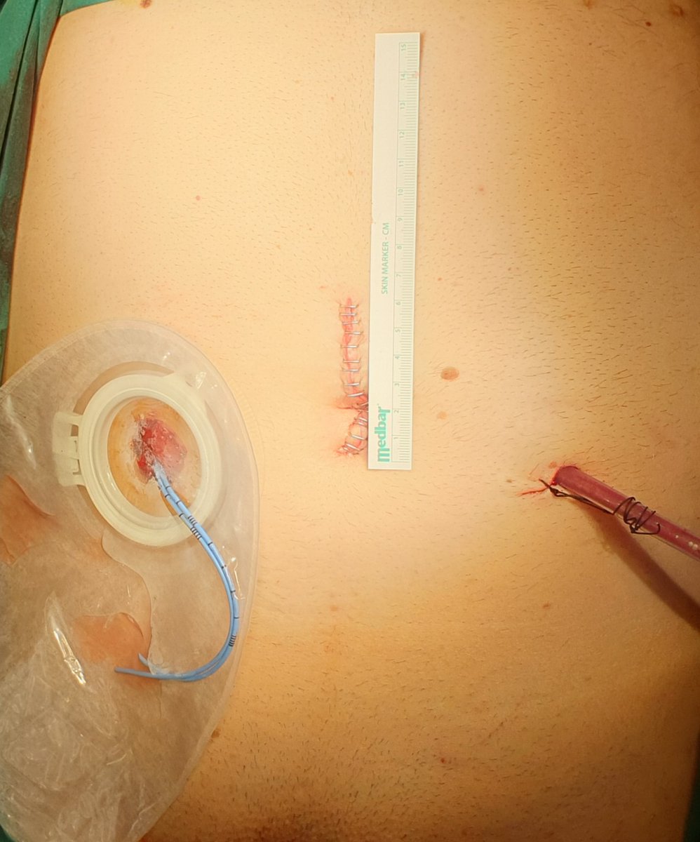 Laparoscopic radical female cystectomy +ileal conduit

Please click the link below to watch the full of operation

👉 youtube.com/watch?v=waS1bH…

#urology #femalecystectomy #laparoscopy #bladdercancer 

<a href="/KartalUroloji/">KARTAL ÜROLOJİ</a> <a href="/CubukAlkan/">Alkan Çubuk</a> <a href="/Orkunt8/">Orkunt özkaptan</a>