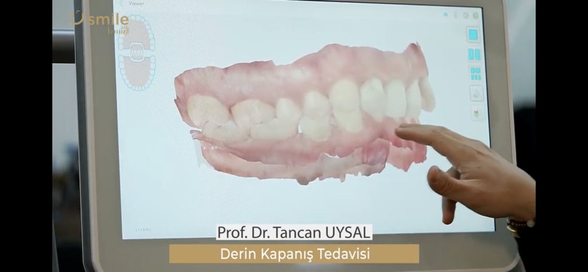 Derin Kapanış - Örtülü Kapanış (Deep Bite) Nedir? Şeffaf Plaklarla Teda... youtu.be/blg1R05anI4 <a href="/YouTube/">YouTube</a> aracılığıyla