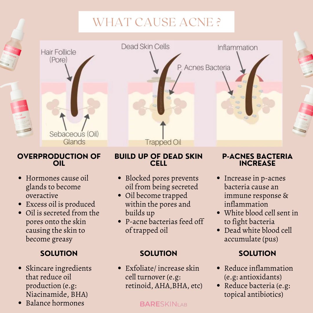 bareskinlab's tweet photo. Utk dapat solution for your acne, kena tahu what cause the acne. Basically ada 3 sebab acne ni terjadi which are overproduction of oil, build up of dead skin cell and P-acnes bacteria increase. https://t.co/66iXncCgm0